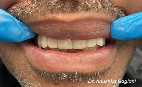 Implant Restorations Chicago