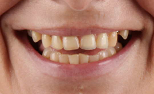 TruBlu Dentistry | Dental Fillings, Teeth Whitening and E4D