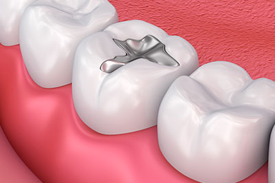 TruBlu Dentistry | Implant Dentistry, Dental Fillings and Laser Dentistry