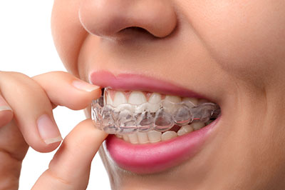 Invisalign in Chicago